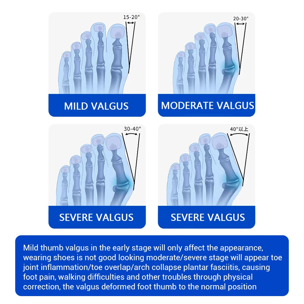 PASTSKY Bunion Corrector Toe Separator Braces Orthotics Hallux Valgus